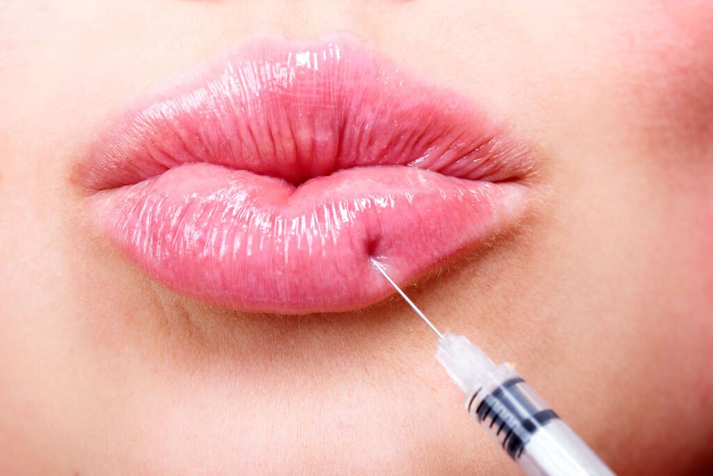 filler injection in lips