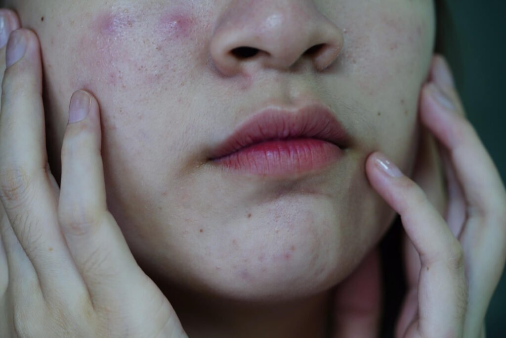Acne pimple and scar on skin face